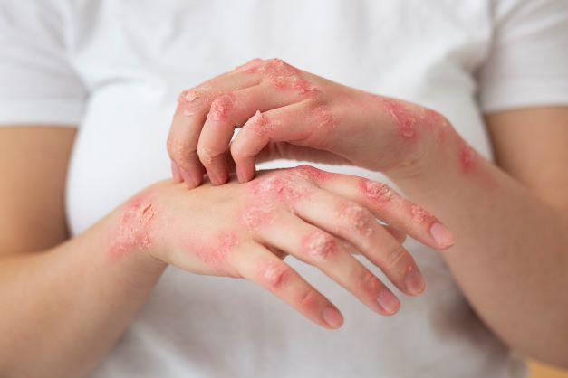 Occupational contact dermatitis